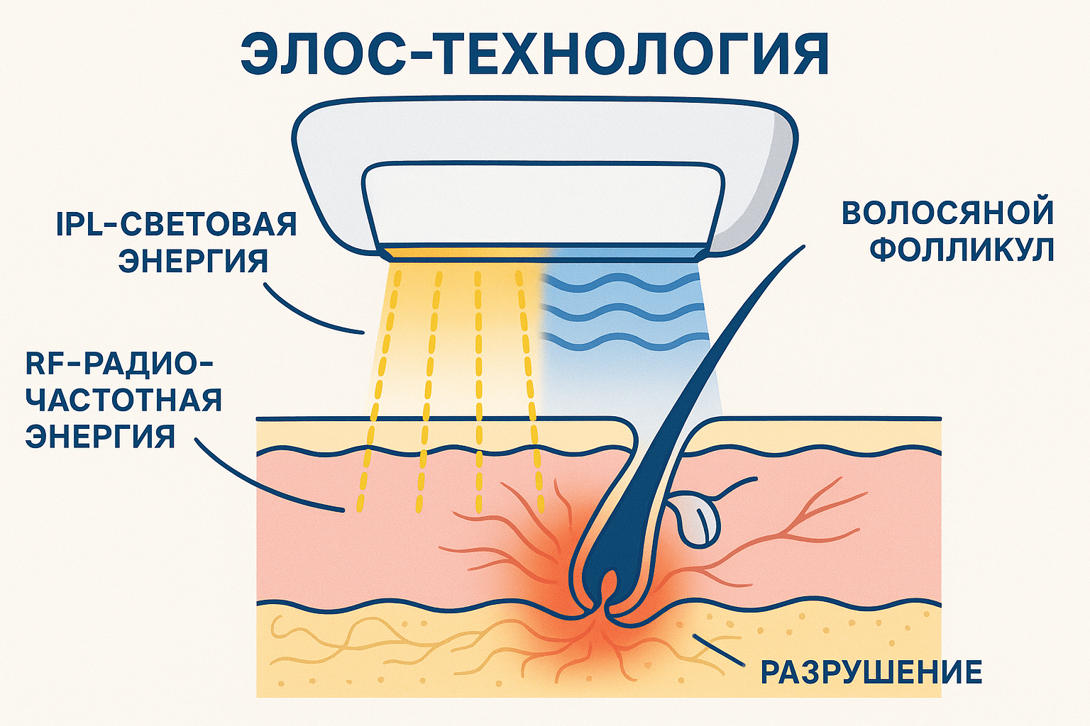 Принцип ELOS технологии Magneto 360